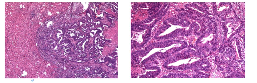升结肠癌肝转移，如何实现治愈“神话”？|病例分享
