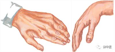 指尖发麻有针刺感看什么科室,左手拇指食指发麻针灸怎么治疗