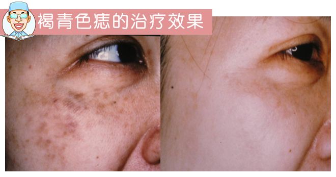 褐青色痣和斑的区别,褐青色痣斑是怎么形成的