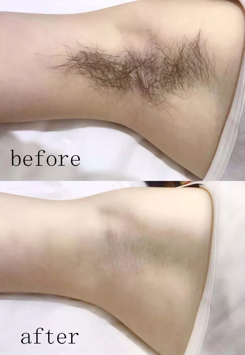 有没有一款真正永久脱毛的脱毛膏,你还在用剃须刀刮胡子吗