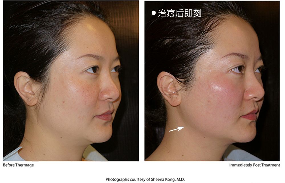 热玛吉抗衰老手术适应6类人群,了解热玛吉抗衰老看这篇就够了