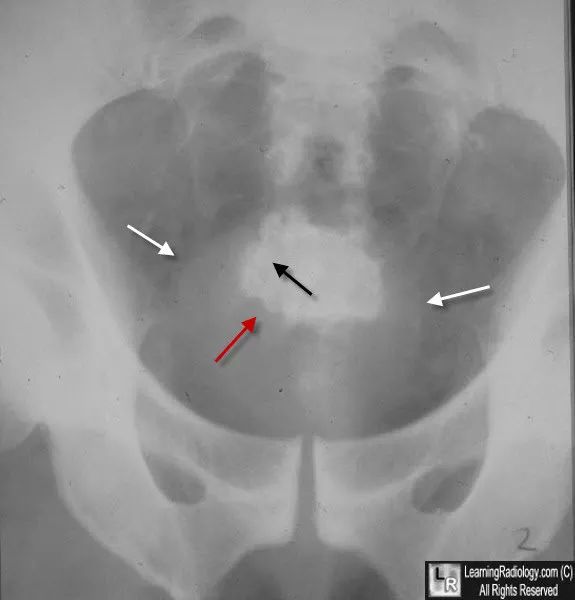 膀胱结石影像,描述膀胱结石在b超中的影像表现
