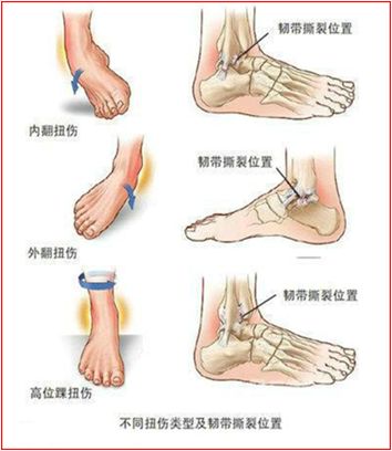 崴脚了医生建议拍片吗,崴脚后核磁可以看到软骨损伤么
