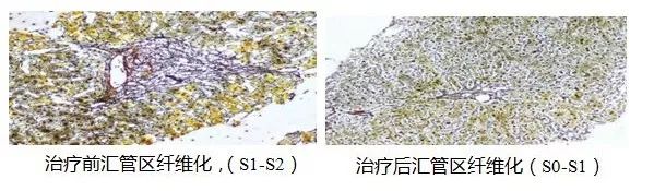 乙肝病毒携带者治疗费用高吗,乙肝携带者需不需要治疗