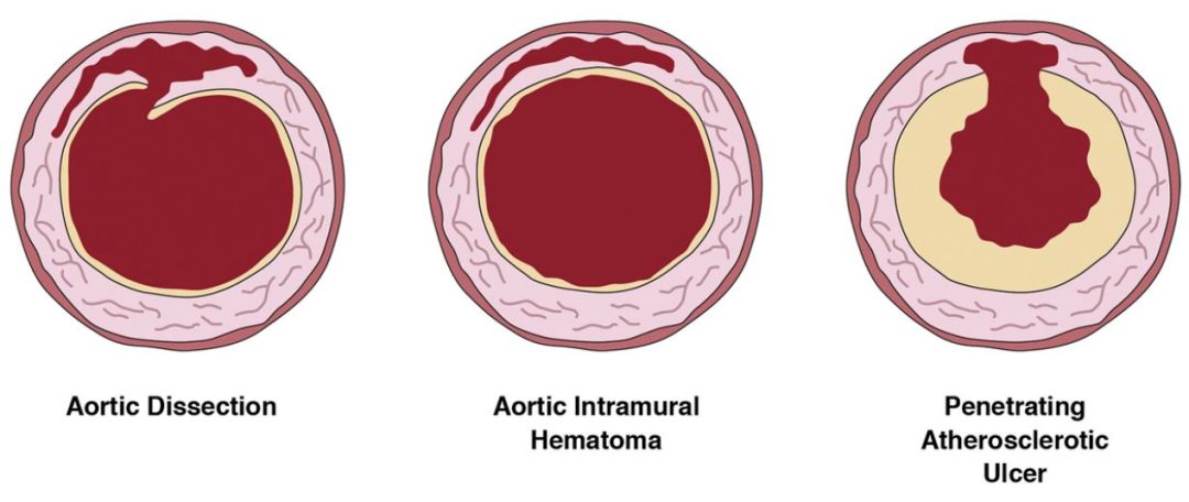 急性主动脉综合征怎么判断,急性主动脉综合征包含几种疾病