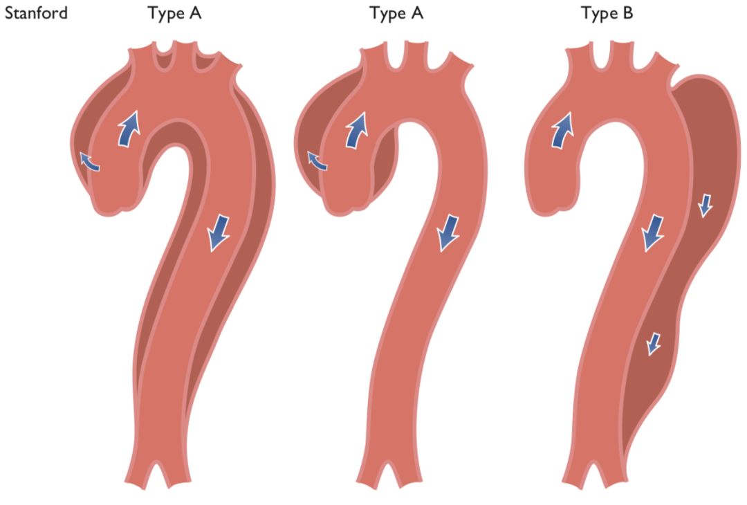 急性主动脉综合征怎么判断,急性主动脉综合征包含几种疾病