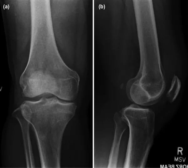 同一部位痛风是什么原因,痛风同个地方反复发作