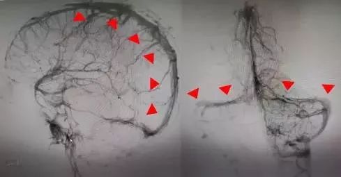 26岁小伙加班后头晕,28岁小伙熬夜加班49小时