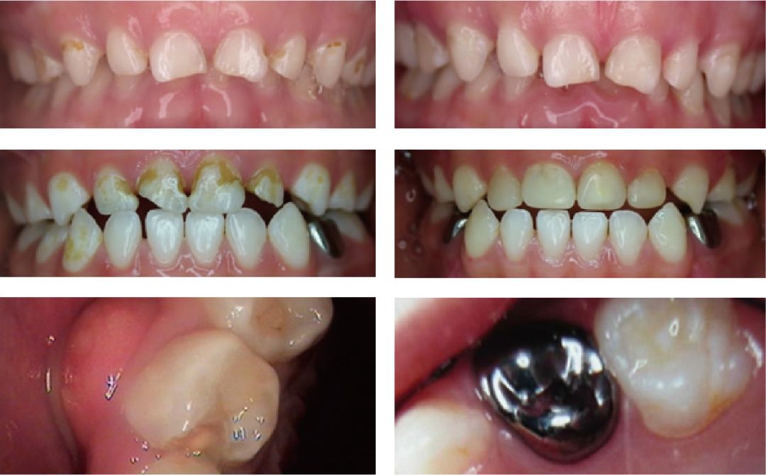 关爱口腔预防龋齿,爱牙科普小实验