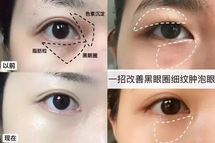 马应龙紧致型眼膜,马应龙眼膜视频