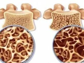 骨折骨质疏松吃什么钙片好,不是发育期吃钙片有用吗