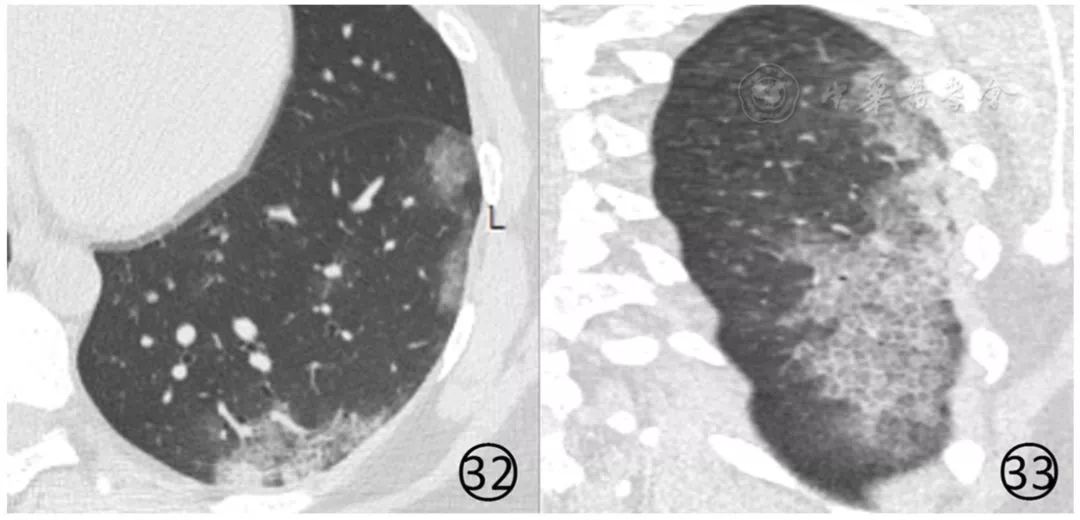 新冠肺炎影像演变过程,新冠肺炎胸部影像学特点有哪些