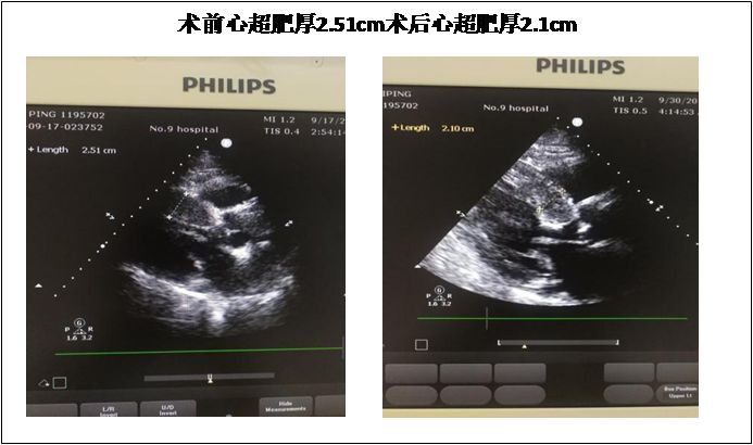 扩张型心肌病用什么消融,梗阻性肥厚性心肌病开胸手术恢复