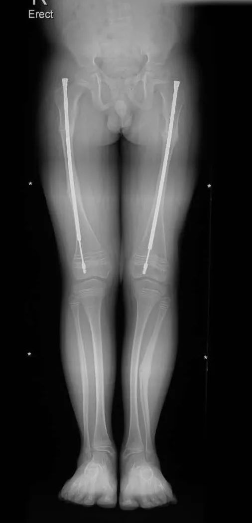 细微的骨折是一种怎样的疼痛感,骨折的疼痛有一群人要体会几十次