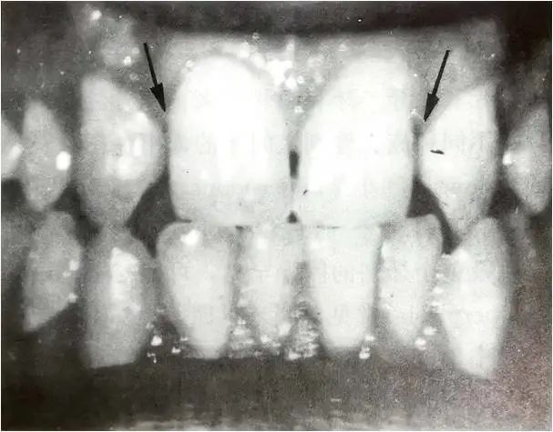 牙齿离奇失踪,牙齿诡异事件