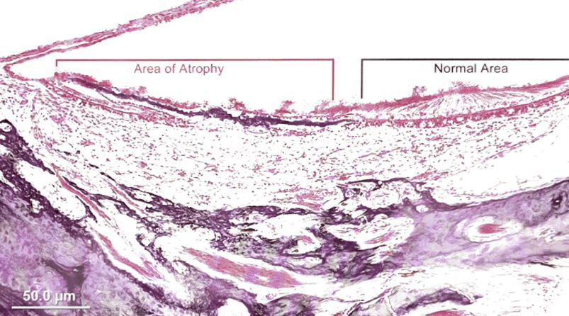 22张图，细说梅尼埃病的组织病理学特点丨“晕”筹帷幄