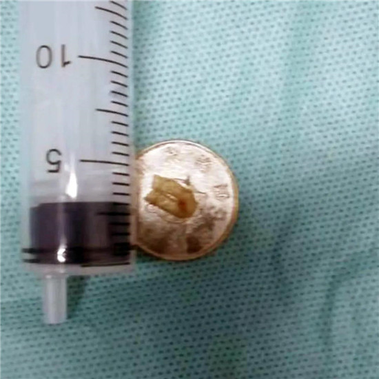 惊险！唐山妇幼耳鼻喉科一天收治7例异物患者