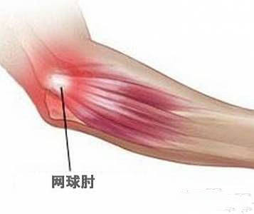 网球肘疼痛难忍别慌试试这个方法,网球肘痛用针刺激穴位可以吗