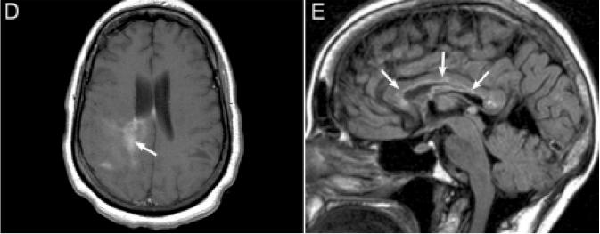 张星虎视神经脊髓炎,张星虎多发性硬化