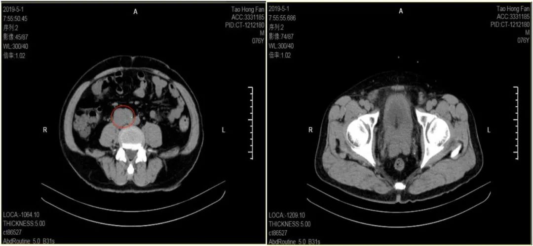 高危型mhv阳性,高危阳性tct非典型鳞状上皮病变