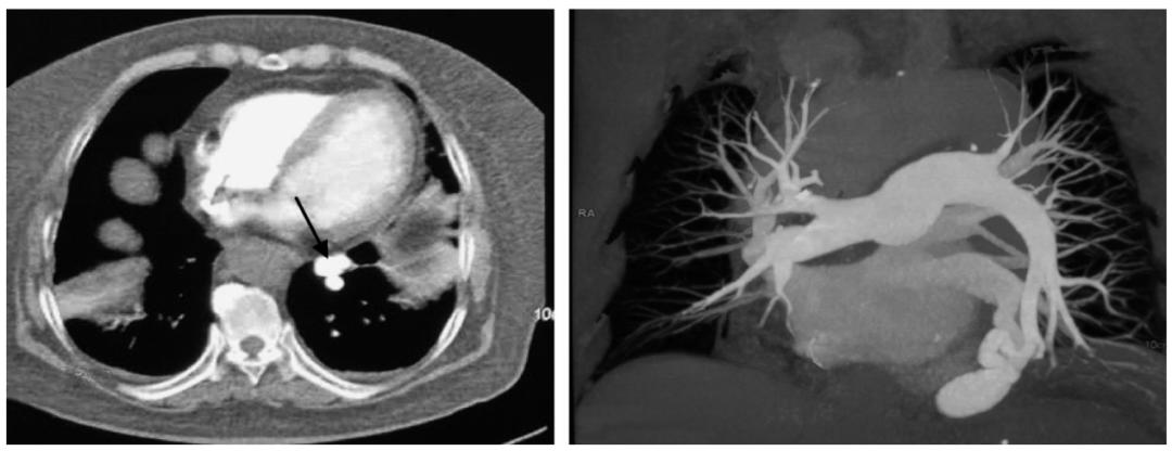 肺动脉血管畸形症状,肺动脉畸形华西医院