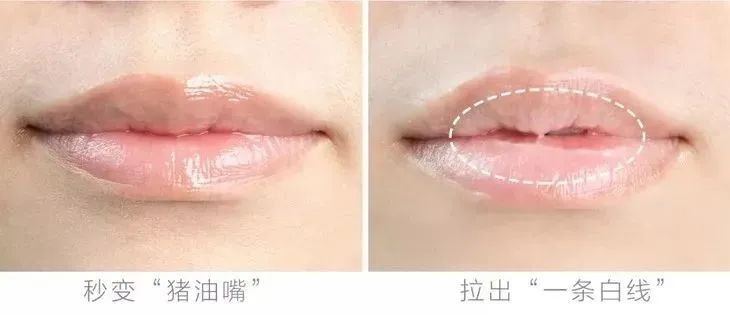 嘴唇干裂起皮等皮掉了涂唇膏,嘴唇干脱皮用什么唇部护理比较好?