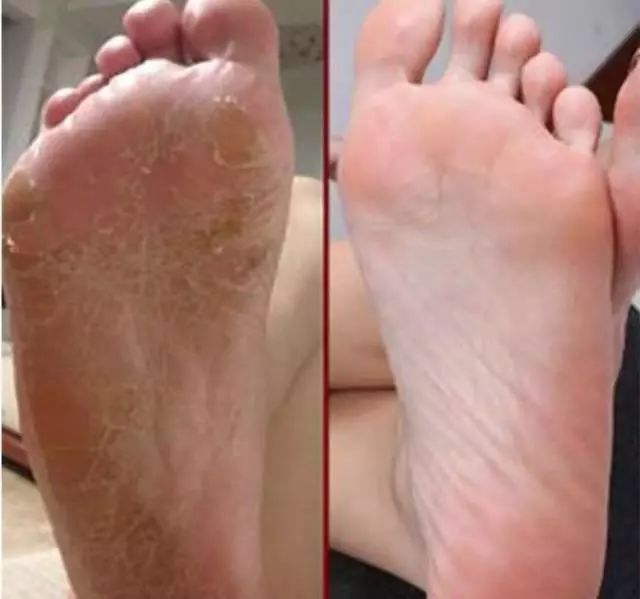 美脚神器哪个效果最好,美脚神器去角质呵护足底