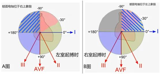 心电图显示心室起搏,心电图电极v4位置