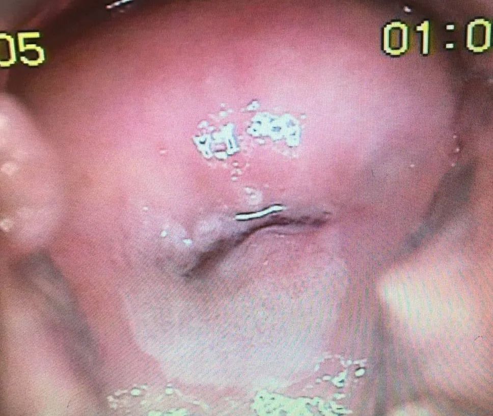 处女膜仍在的17岁孕妇，罕见双宫颈的35岁女人……那些不想用手术刀的妇科术者