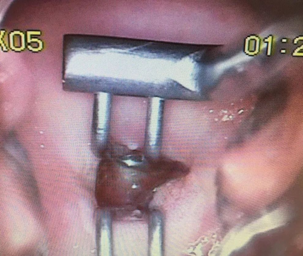 处女膜仍在的17岁孕妇，罕见双宫颈的35岁女人……那些不想用手术刀的妇科术者