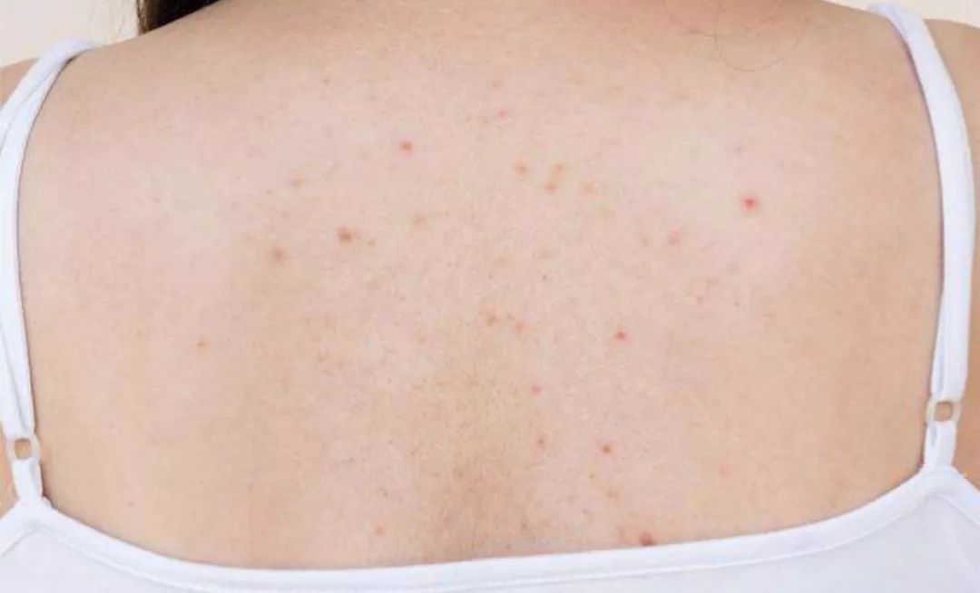 日本绿瓶的祛痘喷雾叫什么,清爽型祛痘喷雾