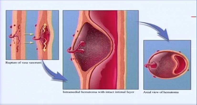 胸痛的诊断与鉴别诊断心得,急性胸痛的诊断思路和方法