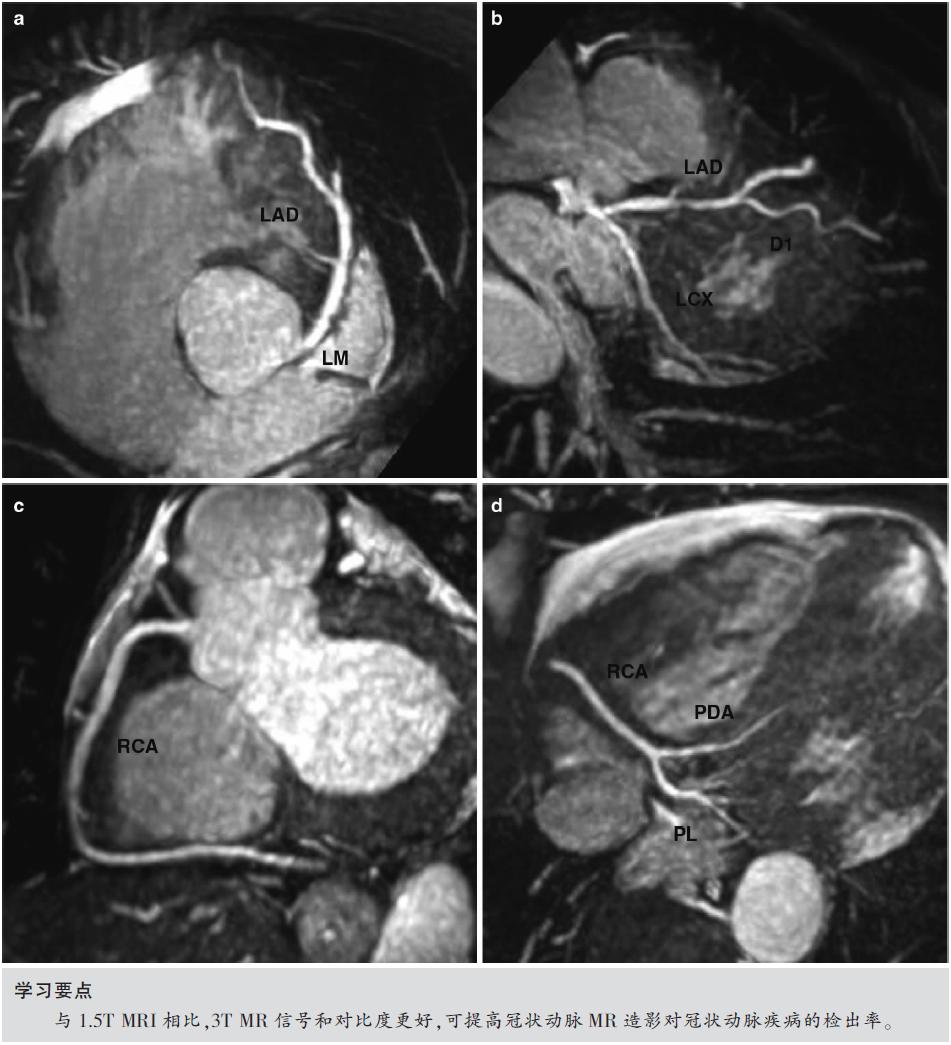 怎么看懂ct冠状动脉造影图片,冠状动脉造影图讲解