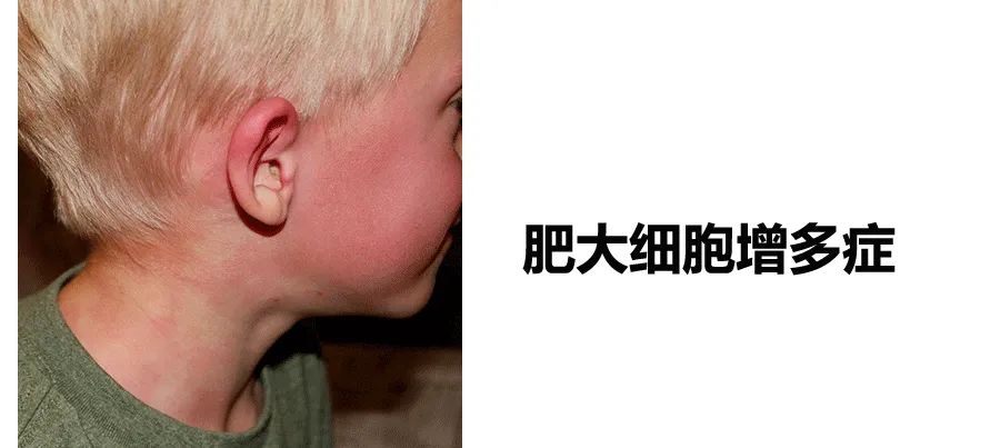 耳垂很红并发肿,耳朵上耳廓水肿图片