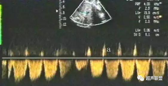 胎儿宫内窘迫如何判断,38周如何判断胎儿宫内窘迫或缺氧