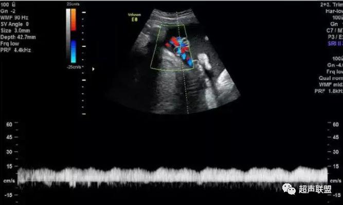 胎儿宫内窘迫如何判断,38周如何判断胎儿宫内窘迫或缺氧