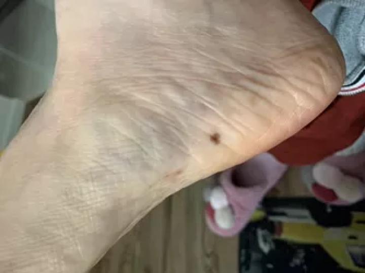 黑痣癌变的痣会很大吗,黑痣癌变一般是一个痣还是好多