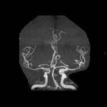 左侧大脑后动脉开窗畸形图片,脑部基底动脉开窗畸形如何治疗