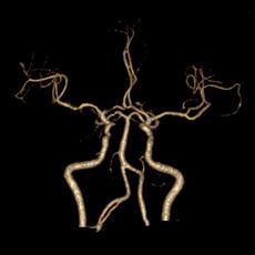 左侧大脑后动脉开窗畸形图片,脑部基底动脉开窗畸形如何治疗