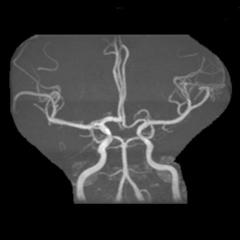 左侧大脑后动脉开窗畸形图片,脑部基底动脉开窗畸形如何治疗