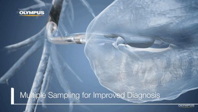 盘点医院各大科室侵入性检查：穿刺、内镜各显神通，小活检标本以“小”见“大”