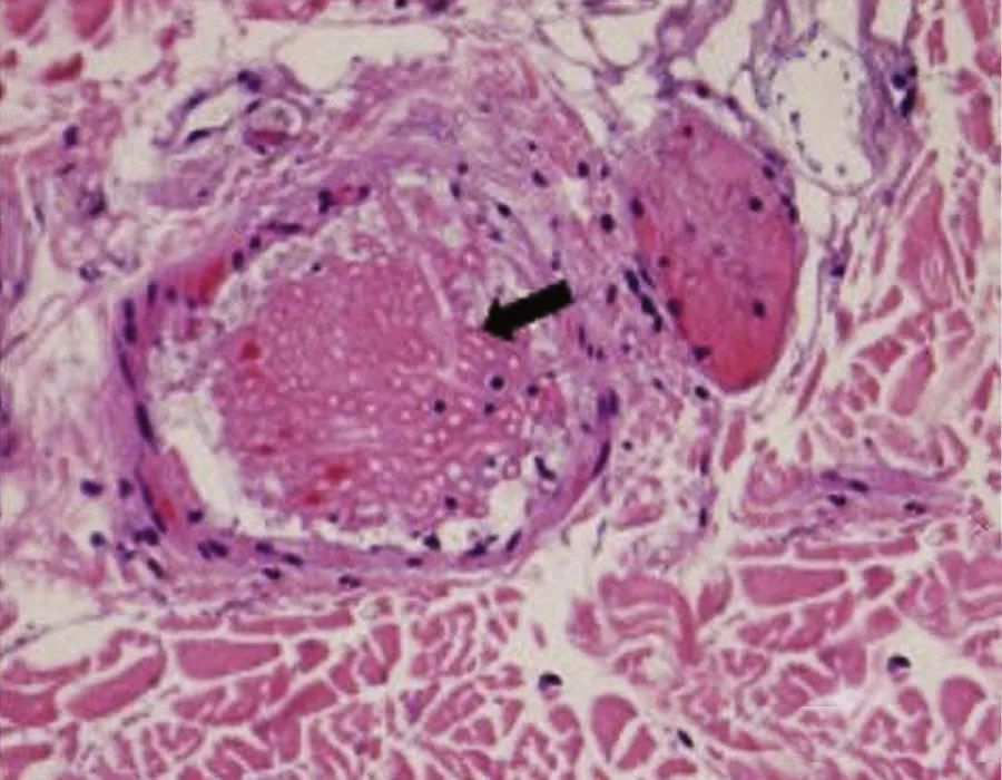 化疗后严重细菌感染肺炎,化疗后感染多重耐药菌