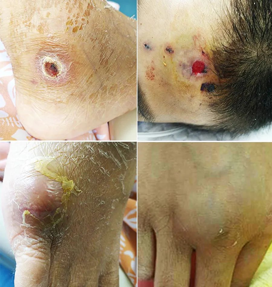 化疗后严重细菌感染肺炎,化疗后感染多重耐药菌