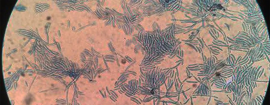 化疗后严重细菌感染肺炎,化疗后感染多重耐药菌