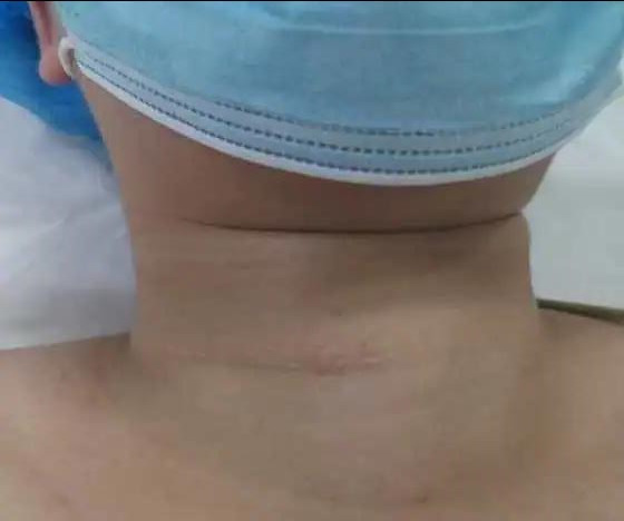 唐山中心医院做甲状腺手术多少钱,甲状腺手术中神经检测怎么插管