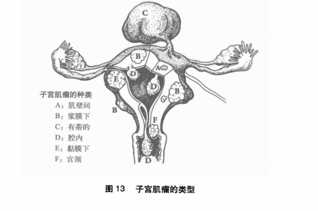 更年期子宫肌瘤方子,更年期子宫肌瘤最佳治疗方法