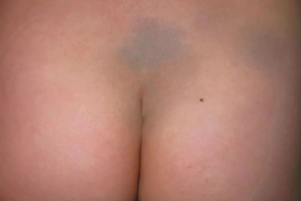 宝宝眼睛下面发青鼻子有青筋,宝宝鼻梁上有淤青怎么回事