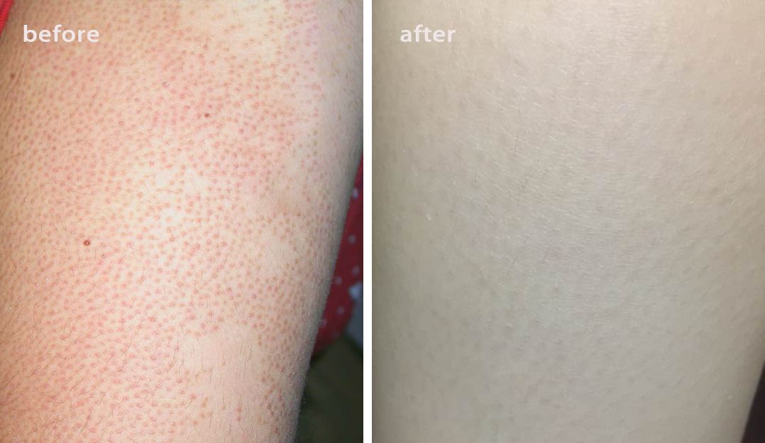 别放弃，烦人的“鸡皮疙瘩”，真的还可以再救一下