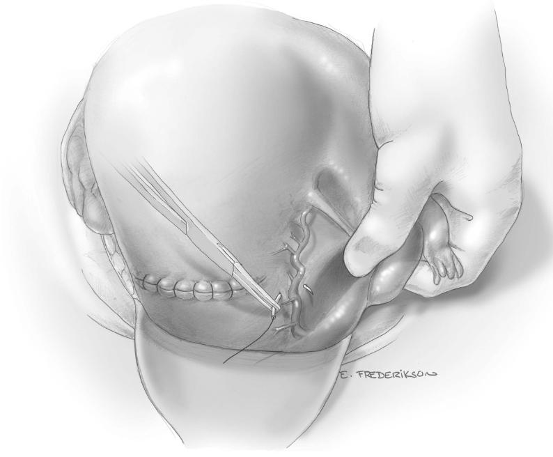产后出血的诊疗规范,简述产后出血抢救措施