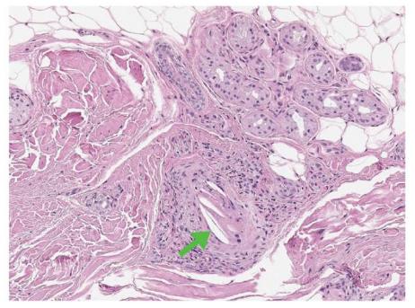 95岁老爷爷脚趾变形,90岁老人脚趾头发黑怎么办